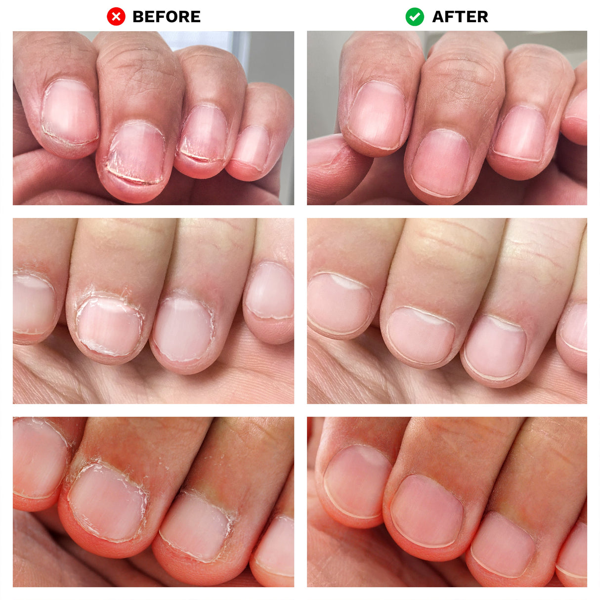 No Bite Nail Recovery | Nail Care - Sumiye Co